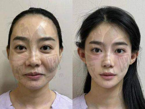 综上所述，北京加减美、北京蒂凡妮、北京黄寺这三家都是北京有名的面部年轻化医院。每家医院在面部提升方面都有各自的特色，而且价格透明合理。大家可以根据自身的需求和经济状况，放心选择其中一家来实现面部年轻化。