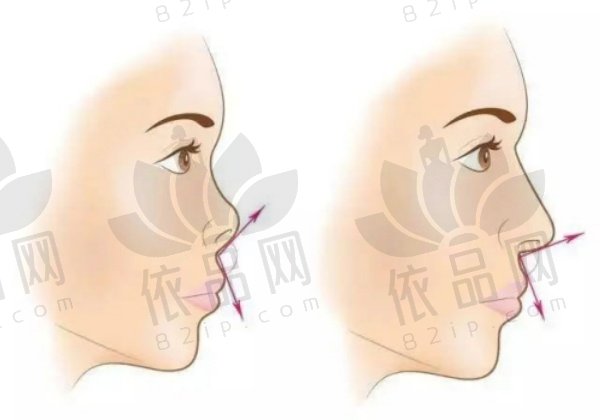 成都美莱做鼻子好的医生：黄小林做鼻子技术好，隆鼻价格9800元起
