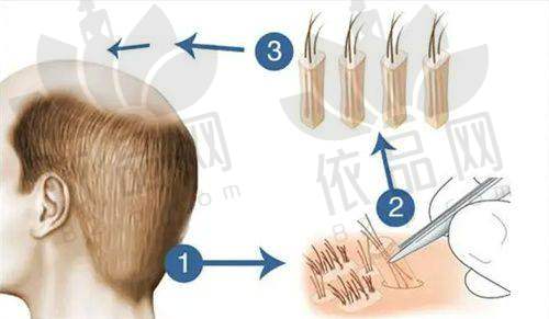 广州崇爱植发医院收费贵吗？价格表如下