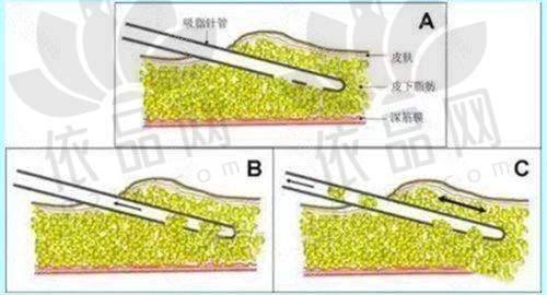 合肥假体隆胸价格参考