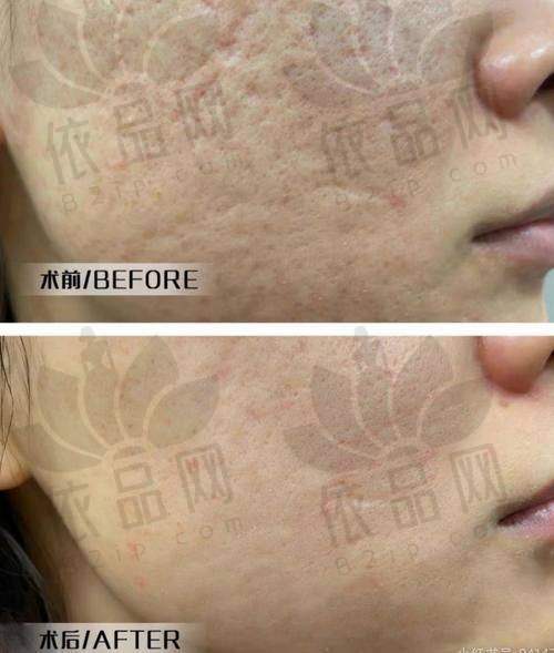 合肥艺星黄金微针的成效与适用范围