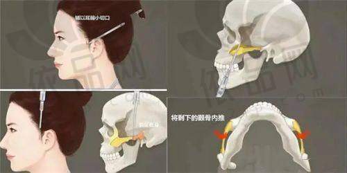 长春博泰医院：弗缦胶原蛋白适合泪沟卧蚕填充，注射舒适感高
