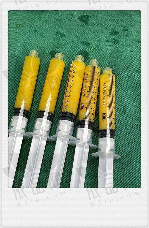 二、武汉亚韩何佳医生大腿抽脂的优势