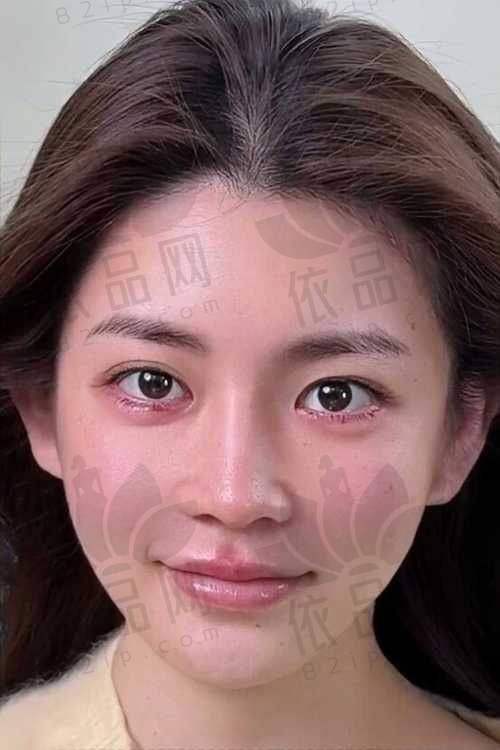 合肥艺星热玛吉项目优势