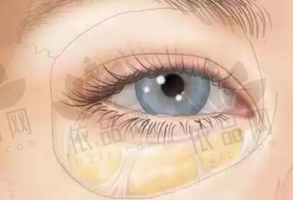 哈尔滨双燕嘎眼袋咋样？技术先进方案个性，2200元起还恢复快获顾客好评
