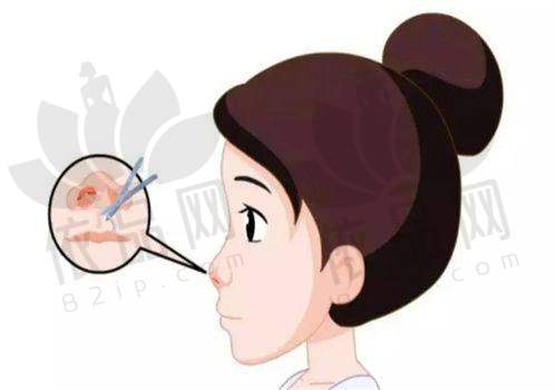 2025哈尔滨双燕医美大腿吸脂价格
