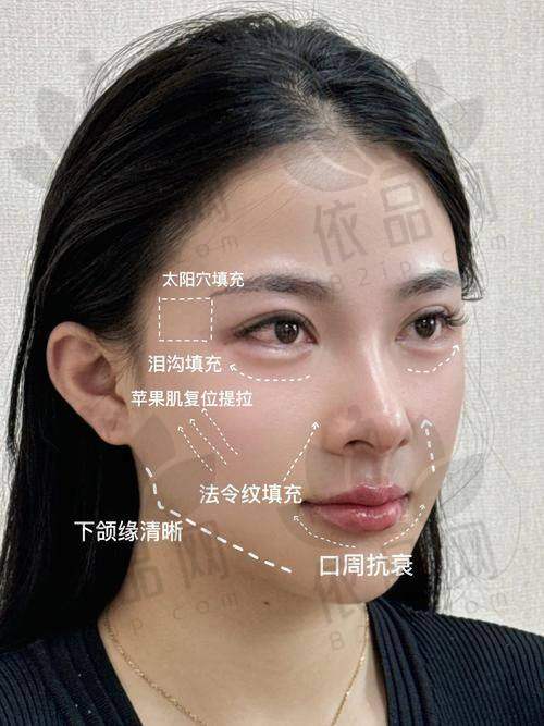 总的来说，如果你希望改善面部结构、让面部中部更立体协调，李运峰医生在成都东篱医院提供的颧骨内推手术是个特别实用的选择。不论是制定手术方案的严谨性、手术操作的稳定度，还是术后修复体系的贴心度都表现良好。医院有完善的整形流程、预约方式灵活、手术安心性高、性价比也不错。如果你也在寻找颧骨内推医生，不妨询问成都东篱医院李运峰医生团队，开启专属于你的容貌提升之路吧。