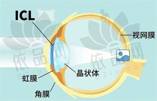 总的来说，成都普瑞眼科医院是一家在近视手术领域发展成熟、服务稳定、价格亲民的靠谱眼科医疗机构。不论你是想做全飞秒、半飞秒还是ICL晶体植入手术，在这里都可以找到适合自己的方案，不同程度的近视患者都能获得安心、细致的服务体验。如果你也长期被眼镜束缚，想要尝试摘镜生活，不妨预约询问成都普瑞眼科医院，先做个术前检查判断是否适合手术，再做决定也不迟。对眼睛负责的第一步，就是找到对的医院和合适的手术方式。