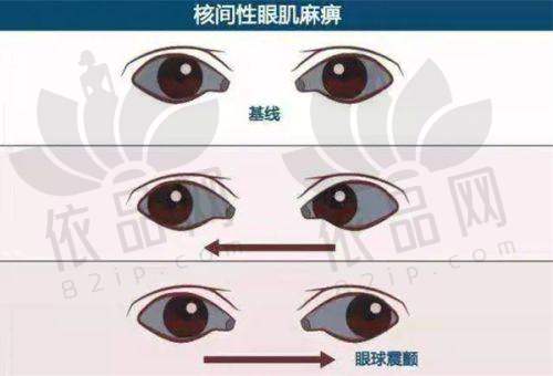 成都普瑞眼科医院弱视治疗靠谱吗？多维度优势证明其治疗值得患者信赖
