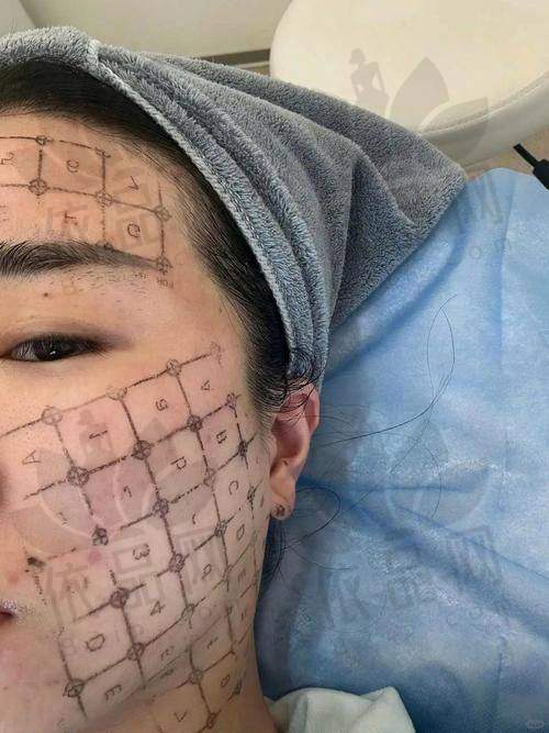 精良的设备型号——五代热玛吉FLX