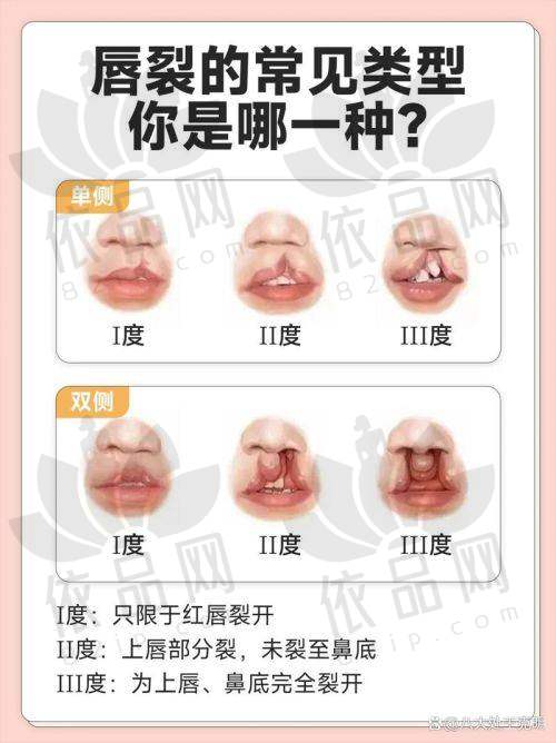 成都李献和医生唇裂二期修复16800起，个性方案，技术优口碑好