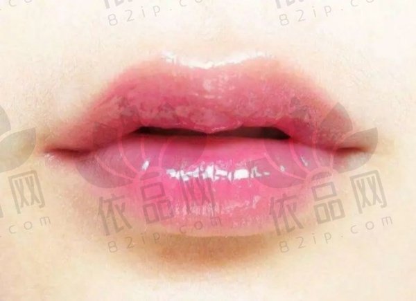 广州美莱富娜医生玻尿酸丰唇1188元起，自然持久，精细手法打造协调美唇！
