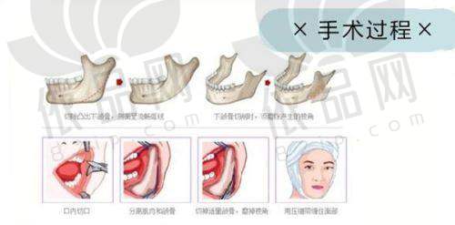 三、四川友谊医院整形美容科双眼皮实例