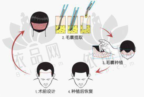 综上所述，武汉仁爱医院植发科无论是从正规性、靠谱程度还是价格方面，都表现出色，是发友们植发的理想选择。