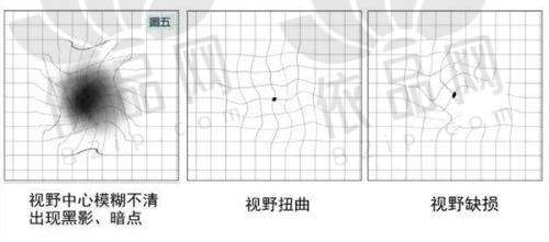 青岛华厦眼科陈国民医生半飞秒手术9800元起，7维跟踪+智能脉冲优势显著