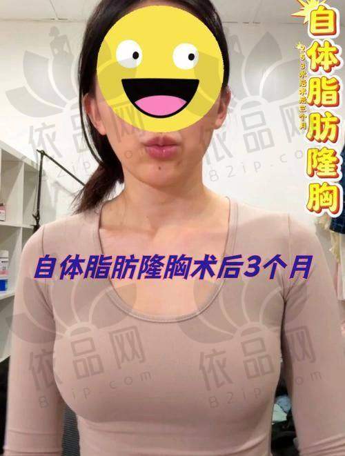 脂肪隆胸项目价格