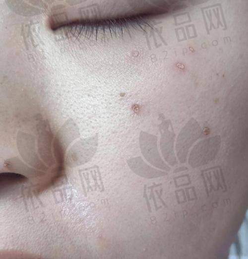 赣州韩美整形美容医院点痣的常见疑问解答
