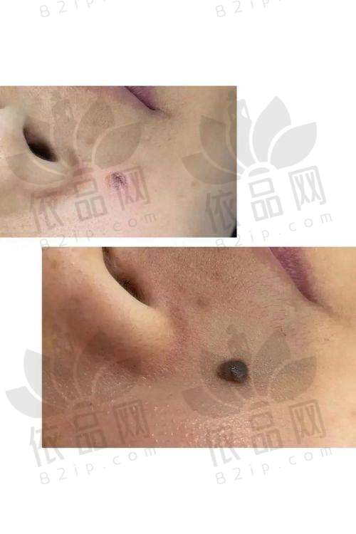赣州韩美整形美容医院点痣的实例分享