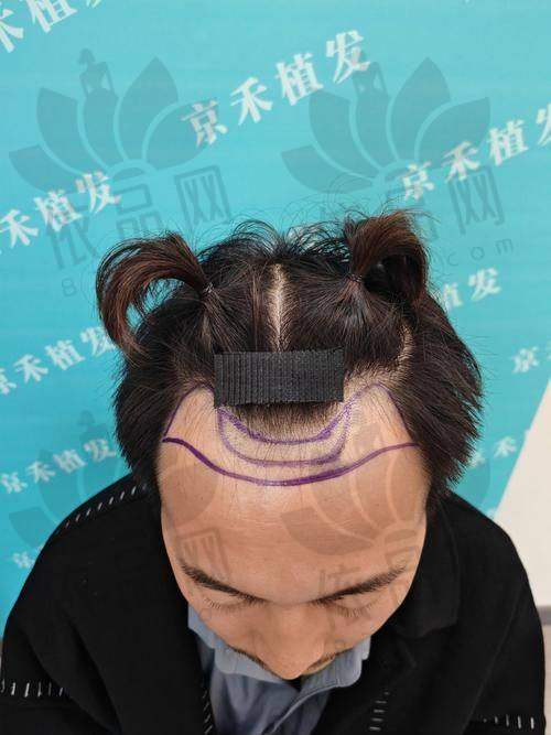 武汉仁爱医院种发际线价格实惠