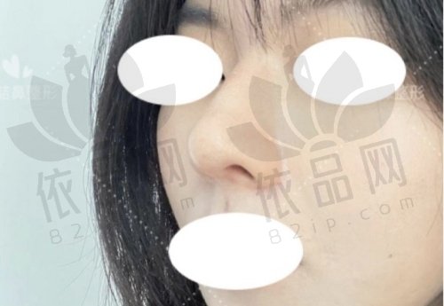 深圳博爱曙光刘波做鼻子半肋25000元起，个性化方案微创操作，术后鼻型自然受好评