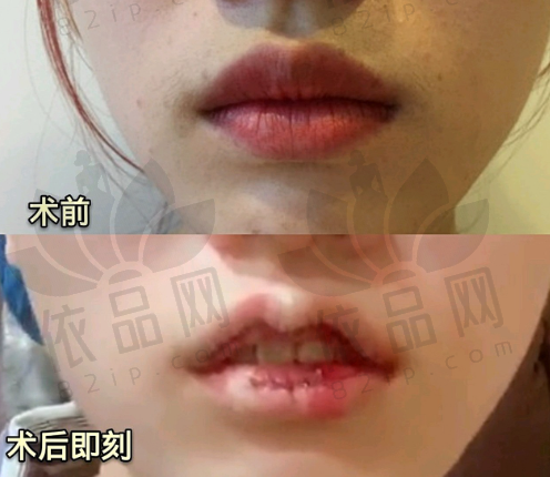 选择刘波医生做鼻子的优势总结