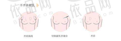二、提眉术的原理与目的
