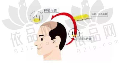 天津排行前十名微创植发医院