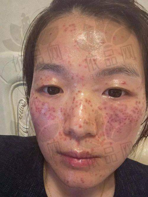 深圳博爱曙光医院治疗结果不易反弹