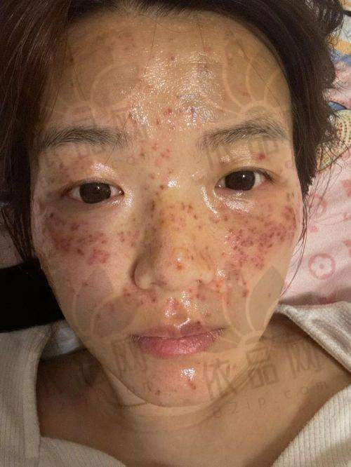 深圳博爱曙光医院祛斑技术优势显著