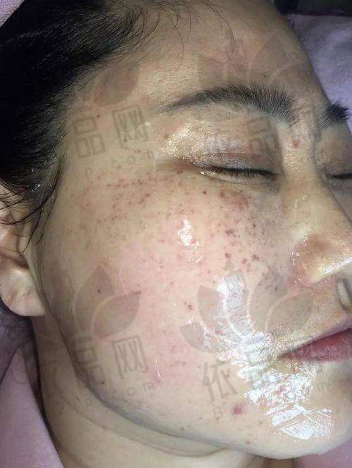 深圳博爱曙光医院祛斑怎么样？口碑、技术、医师优，效果好不易反弹获好评