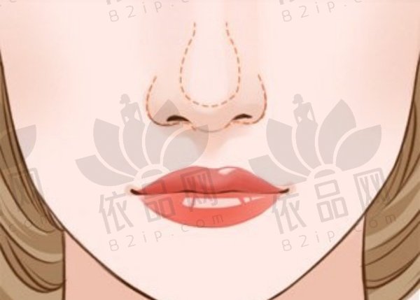广州美莱廖轶平手术缩鼻翼8000元起，精细操作塑造自然精致美鼻！