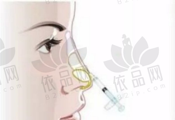 广州美莱廖轶平膨体隆鼻29800元起，线条流畅避免“假鼻”，术后改善快！