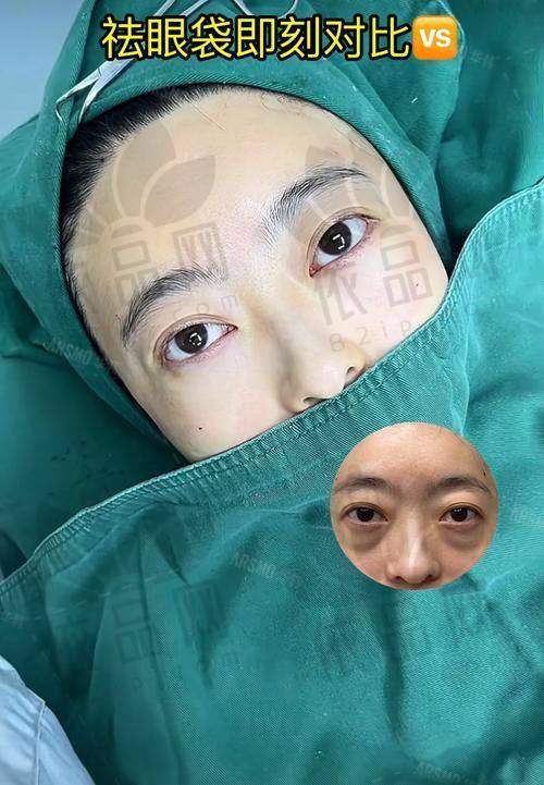 美莱4D隐形祛眼袋：特色技术优势显著