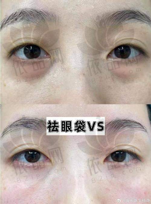 广州美莱陈贵宗内切祛眼袋仅3680元起，4D隐形技术分型治疗，即做即走不留痕