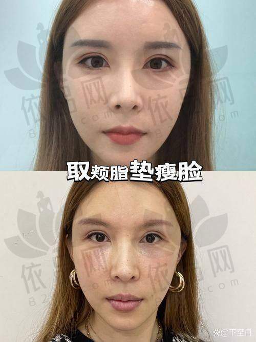 四、深圳阳光陈群面部脂肪填充的价格
