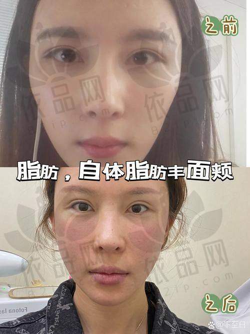 二、面部脂肪填充的原理和优势