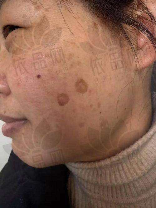 在激光祛斑这件事上，还是要选择正规的大机构才更让人放心。2025年贵阳激光祛斑，贵阳利美康外科医院、贵阳华美紫馨整形医院、贵阳美莱医疗美容医院这三家医院实力强劲。告别暗沉的色素斑，重拾年轻活力。有需求的朋友们赶快行动起来，谁不想美美的出门，活出精彩自我呢？贵阳利美康、华美、美莱这三家医院都是正规资质的连锁品牌，在国内有名度高，值得信赖。