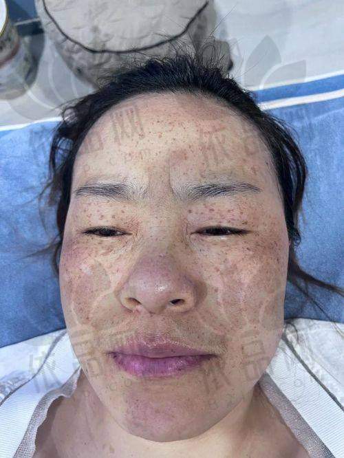 贵阳激光祛斑优质医院推荐