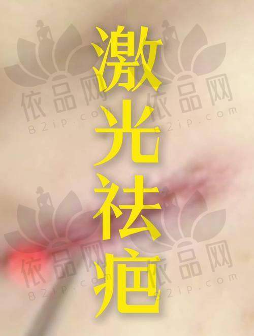 一、吉大一院整形科疤痕修复价格