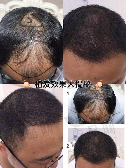 二、成都恒美植发（总院）