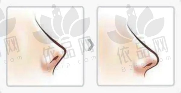 武汉五洲做鼻综合怎么样？技术多样医生强，价格合理打造个性化美鼻效果