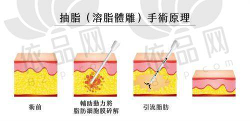 2025苏州维多利亚整形医院吸脂塑形价格表