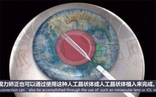 各医院近视手术价格详情