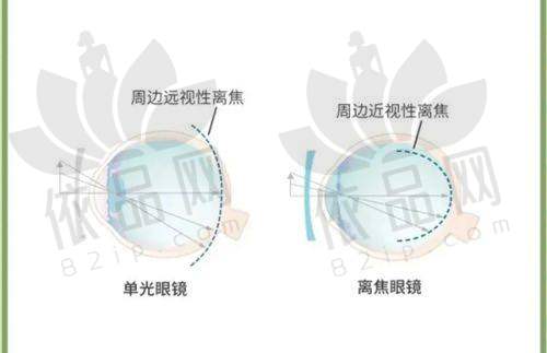 影响张家界近视手术价格的因素