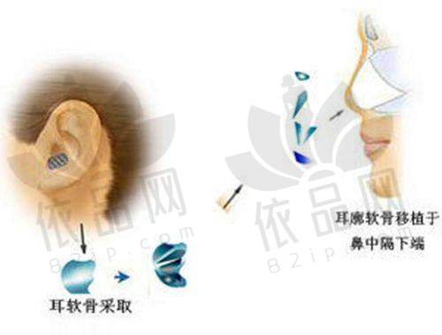 武汉鼻子整形常见问题解答
