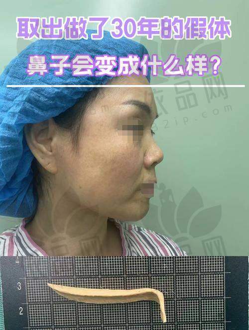 通过对深圳多家具备鼻部假体取出手术项目的医院简要剖析可见，选择医院时应结合自身需求、预算情况、术后期望等多方面因素综合考量。一些国有综合医院提供较高的诊疗标准与制度保护，而医美类机构则在体验细节和术后服务上更具特色。同时，价格自几百元至上万元不等，灵活多样，满足了不同层次消费者的选择需要。如果你正在考虑进行鼻部假体取出手术，建议提前预约、进行面诊，与医生沟通实际情况后再做决定。若仍对医院筛选存在疑惑，欢迎通过平台留言询问，我们将提供更具针对性的服务建议和医疗信息辅助。