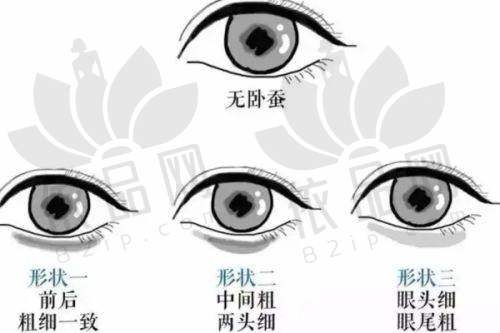 五、余文林唇裂修复需要进行几次手术？