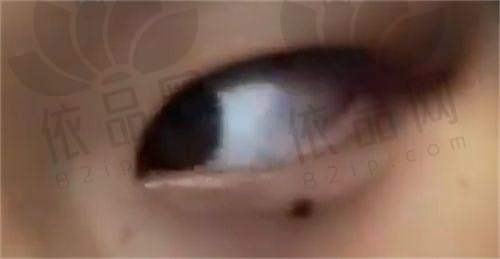 三、余文林能修复唇裂鼻畸形吗？