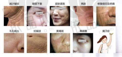 东国水光针的注意事项