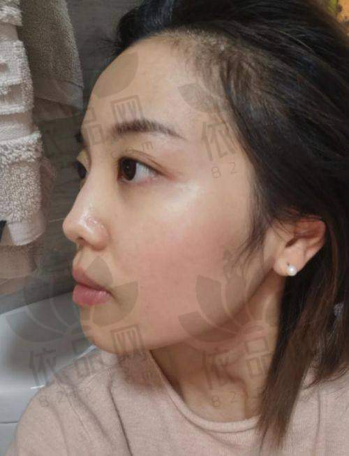 哈尔滨美辰整形黑金超光子项目价格
